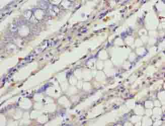 C1orf101 Antibody - Immunohistochemistry of paraffin-embedded human colon cancer using antibody at dilution of 1:100.