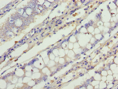 C1orf101 Antibody - Immunohistochemistry of paraffin-embedded human colon cancer using C1orf101 Antibody at dilution of 1:100