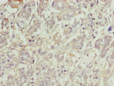 C1orf101 Antibody - Immunohistochemistry of paraffin-embedded human pancreatic cancer using C1orf101 Antibody at dilution of 1:100
