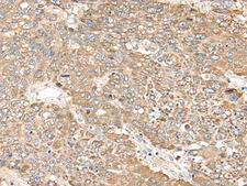 C1orf101 Antibody - Immunohistochemistry of paraffin-embedded Human liver cancer tissue  using C1orf101 Polyclonal Antibody at dilution of 1:65(×200)
