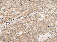 C1orf101 Antibody - Immunohistochemistry of paraffin-embedded Human liver cancer tissue  using C1orf101 Polyclonal Antibody at dilution of 1:45(×200)