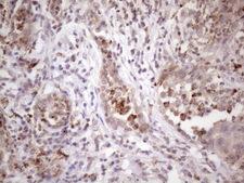 C1orf106 Antibody - Immunohistochemical staining of paraffin-embedded Carcinoma of Human lung tissue using anti-C1orf106 mouse monoclonal antibody. (Heat-induced epitope retrieval by 1 mM EDTA in 10mM Tris, pH8.5, 120C for 3min. (1:150)