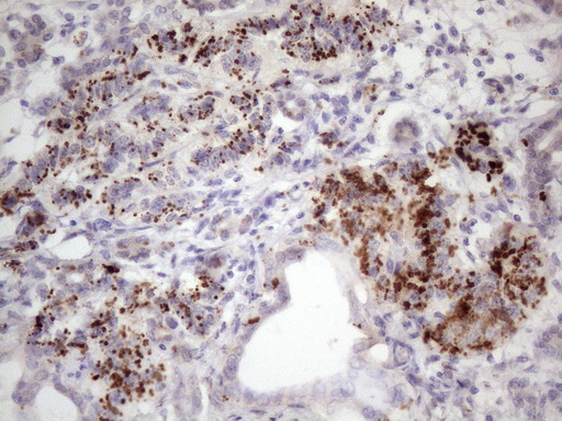 C1orf106 Antibody - IHC of paraffin-embedded Carcinoma of Human pancreas tissue using anti-C1orf106 mouse monoclonal antibody. (Heat-induced epitope retrieval by 1 mM EDTA in 10mM Tris, pH8.5, 120°C for 3min)(1:150).