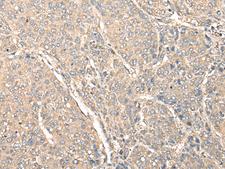 C1orf106 Antibody - Immunohistochemistry of paraffin-embedded Human liver cancer tissue  using C1orf106 Polyclonal Antibody at dilution of 1:80(×200)