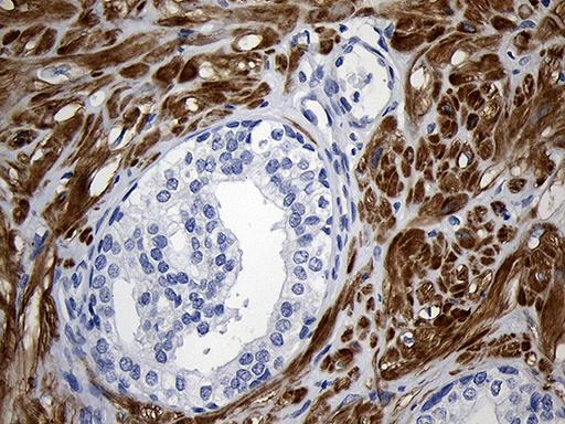 C1orf111 Antibody - Immunohistochemical staining of paraffin-embedded Carcinoma of Human prostate tissue using anti-C1orf111 mouse monoclonal antibody. (Heat-induced epitope retrieval by 1mM EDTA in 10mM Tris buffer. (pH8.5) at 120°C for 3 min. (1:1000)