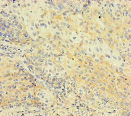 C1orf112 Antibody - Immunohistochemistry of paraffin-embedded human cervical cancer using C1orf112 Antibody at dilution of 1:100
