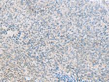 C1orf112 Antibody - Immunohistochemistry of paraffin-embedded Human cervical cancer tissue  using C1orf112 Polyclonal Antibody at dilution of 1:55(×200)