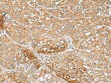 C1orf112 Antibody - Immunohistochemistry of paraffin-embedded Human liver cancer tissue  using C1orf112 Polyclonal Antibody at dilution of 1:110(×200)
