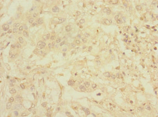 C1orf127 Antibody - Immunohistochemistry of paraffin-embedded human pancreatic cancer using C1orf127 Antibody at dilution of 1:100