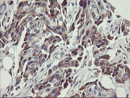 C1orf151 Antibody - IHC of paraffin-embedded Adenocarcinoma of Human breast tissue using anti-C1orf151 mouse monoclonal antibody.