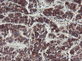 C1orf151 Antibody - IHC of paraffin-embedded Carcinoma of Human liver tissue using anti-C1orf151 mouse monoclonal antibody.
