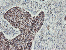 C1orf151 Antibody - IHC of paraffin-embedded Carcinoma of Human lung tissue using anti-C1orf151 mouse monoclonal antibody.