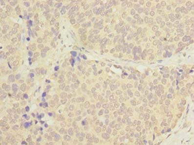 C1orf182 Antibody - Immunohistochemistry of paraffin-embedded human gastric cancer using antibody at dilution of 1:100.