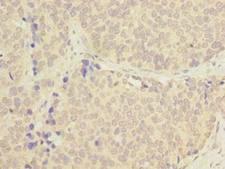 C1orf182 Antibody - Immunohistochemistry of paraffin-embedded human gastric cancer using antibody at dilution of 1:100.