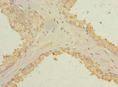 C1orf182 Antibody - Immunohistochemistry of paraffin-embedded human prostate cancer using antibody at dilution of 1:100.