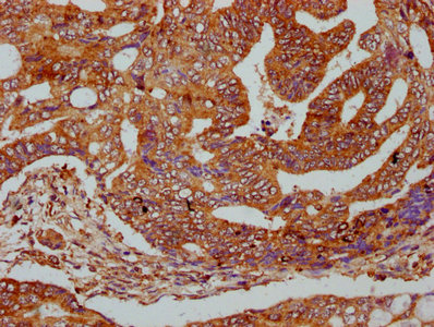 C1orf27 Antibody - Immunohistochemistry Dilution at 1:400 and staining in paraffin-embedded human colon cancer performed on a Leica BondTM system. After dewaxing and hydration, antigen retrieval was mediated by high pressure in a citrate buffer (pH 6.0). Section was blocked with 10% normal Goat serum 30min at RT. Then primary antibody (1% BSA) was incubated at 4°C overnight. The primary is detected by a biotinylated Secondary antibody and visualized using an HRP conjugated SP system.