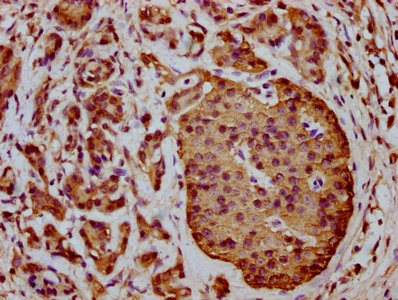 C1orf38 Antibody - Immunohistochemistry Dilution at 1:400 and staining in paraffin-embedded human pancreatic cancer performed on a Leica BondTM system. After dewaxing and hydration, antigen retrieval was mediated by high pressure in a citrate buffer (pH 6.0). Section was blocked with 10% normal Goat serum 30min at RT. Then primary antibody (1% BSA) was incubated at 4°C overnight. The primary is detected by a biotinylated Secondary antibody and visualized using an HRP conjugated SP system.