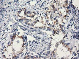 C1orf50 Antibody - IHC of paraffin-embedded Carcinoma of Human lung tissue using anti-C1orf50 mouse monoclonal antibody. (Heat-induced epitope retrieval by 10mM citric buffer, pH6.0, 100C for 10min).