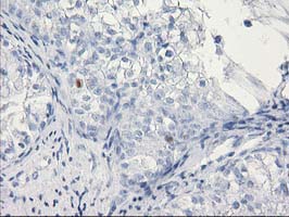 C1orf50 Antibody - IHC of paraffin-embedded Adenocarcinoma of Human ovary tissue using anti-C1orf50 mouse monoclonal antibody. (Heat-induced epitope retrieval by 10mM citric buffer, pH6.0, 100C for 10min).