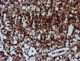C1orf50 Antibody - IHC of paraffin-embedded Carcinoma of Human kidney tissue using anti-C1orf50 mouse monoclonal antibody.
