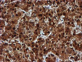 C1orf50 Antibody - IHC of paraffin-embedded Carcinoma of Human liver tissue using anti-C1orf50 mouse monoclonal antibody.