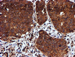 C1orf50 Antibody - IHC of paraffin-embedded Carcinoma of Human lung tissue using anti-C1orf50 mouse monoclonal antibody.