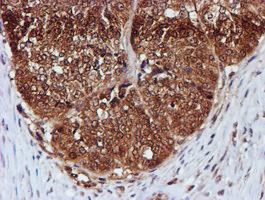 C1orf50 Antibody - IHC of paraffin-embedded Adenocarcinoma of Human ovary tissue using anti-C1orf50 mouse monoclonal antibody.