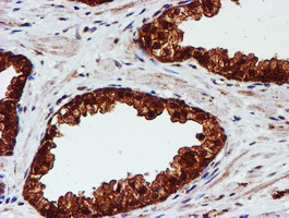 C1orf50 Antibody - IHC of paraffin-embedded Carcinoma of Human prostate tissue using anti-C1orf50 mouse monoclonal antibody.