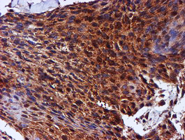 C1orf50 Antibody - IHC of paraffin-embedded Carcinoma of Human bladder tissue using anti-C1orf50 mouse monoclonal antibody.