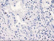 C1orf50 Antibody - IHC of paraffin-embedded Adenocarcinoma of Human ovary tissue using anti-C1orf50 mouse monoclonal antibody.