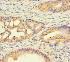 C1orf53 Antibody - Immunohistochemistry of paraffin-embedded human colon cancer using C1orf53 Antibody at dilution of 1:100