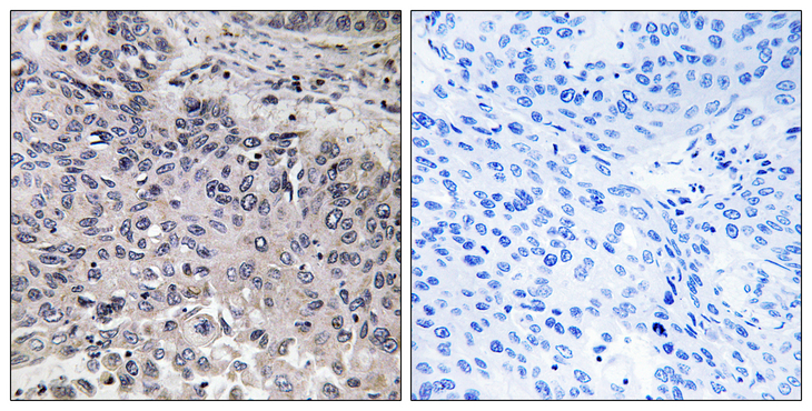 C1QG / Complement C1QC Antibody - Immunohistochemistry analysis of paraffin-embedded human lung carcinoma tissue, using C1QC Antibody. The picture on the right is blocked with the synthesized peptide.
