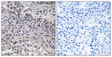 C1QG / Complement C1QC Antibody - Peptide - + Immunohistochemistry analysis of paraffin-embedded human lung carcinoma tissue, using C1QC antibody.