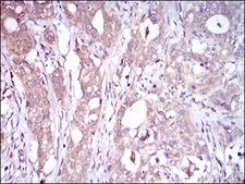 C1qRP / CD93 Antibody - IHC of paraffin-embedded cervical cancer tissues using CD93 mouse monoclonal antibody with DAB staining.
