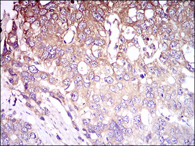 C1qRP / CD93 Antibody - IHC of paraffin-embedded esophageal cancer tissues using CD93 mouse monoclonal antibody with DAB staining.