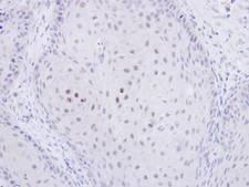 C20orf11 / TWA1 Antibody - IHC of paraffin-embedded Cal27 xenograft using C20orf11 antibody at 1:500 dilution.