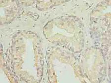 C20orf11 / TWA1 Antibody - Immunohistochemistry of paraffin-embedded human prostate cancer using antibody at dilution of 1:100.