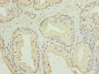 C20orf11 / TWA1 Antibody - Immunohistochemistry of paraffin-embedded human prostate cancer using GID8 Antibody at dilution of 1:100