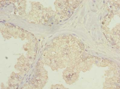 C20orf195 Antibody - Immunohistochemistry of paraffin-embedded human prostate cancer using antibody at dilution of 1:100.