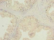 C20orf195 Antibody - Immunohistochemistry of paraffin-embedded human prostate cancer using antibody at dilution of 1:100.