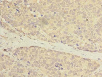 C20orf27 Antibody - Immunohistochemistry of paraffin-embedded human gastric cancer using antibody at dilution of 1:100.