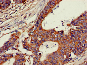 C25H / CH25H Antibody - Immunohistochemistry of paraffin-embedded human colon cancer at dilution of 1:100