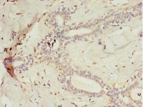 C2orf47 Antibody - Immunohistochemistry of paraffin-embedded human breast cancer using antibody at 1:100 dilution.  This image was taken for the unconjugated form of this product. Other forms have not been tested.