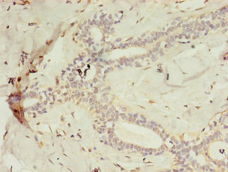 C2orf47 Antibody - Immunohistochemistry of paraffin-embedded human breast cancer using MAIP1 Antibody at dilution of 1:100
