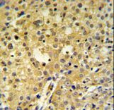 C2orf49 Antibody - C2orf49 Antibody IHC of formalin-fixed and paraffin-embedded human cervix carcinoma followed by peroxidase-conjugated secondary antibody and DAB staining.