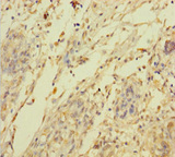 C2orf49 Antibody - Immunohistochemistry of paraffin-embedded human pancreatic cancer using C2orf49 Antibody at dilution of 1:100
