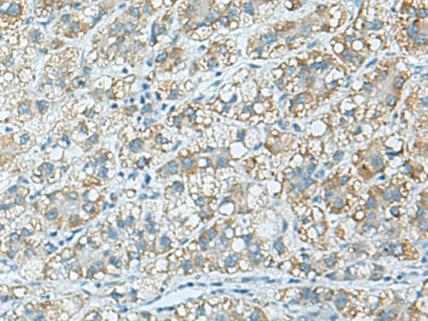 C3AR / C3a Receptor Antibody - Immunohistochemistry of paraffin-embedded Human liver cancer tissue  using C3AR1 Polyclonal Antibody at dilution of 1:100(×200)