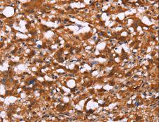 C3orf10 Antibody - Immunohistochemistry of paraffin-embedded Human thyroid cancer using BRK1 Polyclonal Antibody at dilution of 1:40.