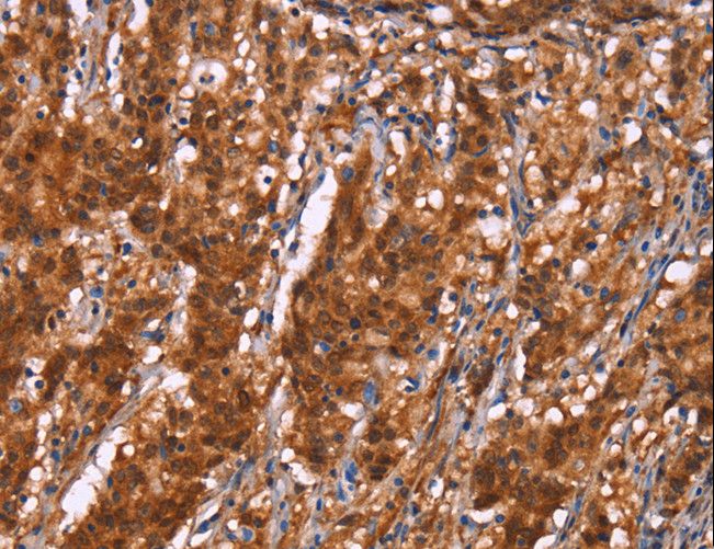 C3orf10 Antibody - Immunohistochemistry of paraffin-embedded Human gastric cancer using BRK1 Polyclonal Antibody at dilution of 1:40.