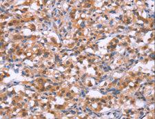 C3orf10 Antibody - Immunohistochemistry of paraffin-embedded Human gastric cancer using BRK1 Polyclonal Antibody at dilution of 1:30.
